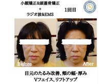 RKY/小顔＆頭蓋骨矯正＋ラジオ波&EMS