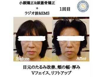 RKY/小顔&頭蓋骨矯正+ラジオ波&EMS