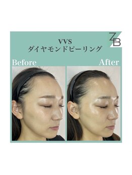 ザラハビューティー(ZARAHA Beauty)/VVSダイヤモンドピーリング
