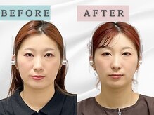 エルシンメトリー矯正院(ailesシンメトリー矯正院)/before＆after　ailes式小顔矯正