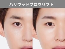 アポロ(Apollo)/ハリウッドブロウリフト