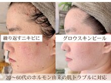 エイミー(Aimee)の雰囲気（肌荒れ/シミ/くすみ/毛穴/跡/ブライダルにも人気◎極上パック付）