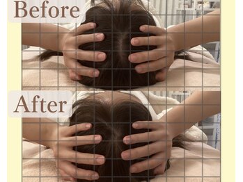 リコ(Rico)/小顔矯正　効果☆頭の大きさ