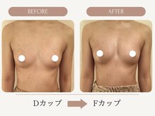 ウェルバスト(Well Bust)/【バストアップ例】D→Fカップ