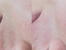 ルイール(LUIRE)の雰囲気（美容液の効果を感じられない方。フェイスワックス始めませんか？）