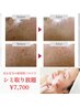 【感動のシミケア☆】長年のシミへ30分ケア放題¥14,800→¥7,700