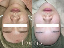 イベリス(Iberis)/ハーブピーリング/韓国肌