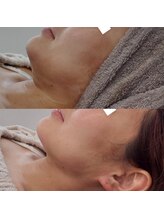 ヴェルシック(Belchic)/くっきりした美しい顎と横顔へ