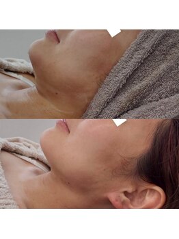 ヴェルシック(Belchic)/くっきりした美しい顎と横顔へ