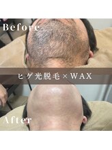 エピナ 千葉店(Epina)/髭MIX脱毛☆