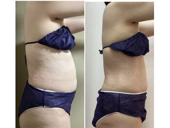 ブリリアント(Brilliant)/お腹周り痩身 50代 12回