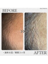 リコロン 銀座(Re:)/男性でも3ヶ月でこれ！