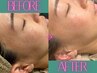 【ふんわり白玉肌×小顔】ハーブピーリング＋無針水光注入　ミコステラ