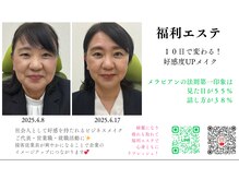 小顔1回・ホワイトスノーピール（首まで）1回・ヘアメイク