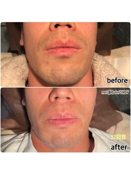 メンズ シンバ(SIMBA)/◯before→after◯