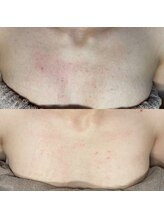 ジョンミー(JONMEE)/ニキビケアにはハーブピーリング