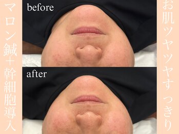 健志接骨院/マロン鍼×幹細胞導入相性抜群！