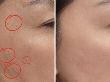 ココリラ(cocorira)/シミ★ラズマ照射シミ◎当て放題