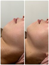 Ottimo Facial Salon/小顔ケア