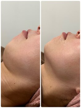 Ottimo Facial Salon/小顔ケア