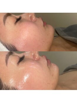 ヴィヴ 熊本(ViV)/【セルマンピーリング】