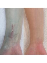 デンドロビューム(Dendrobium)/SPハーブピーリング1回施術