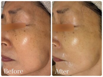 ロイヤル(ROYAL)/たるみ/シワ改善症例