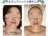 人気No.1【瞬間小顔】MeltyFatフェイシャル,二重顎撃退!75分