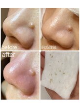 ユヌ(une)/毛穴エクストラクション