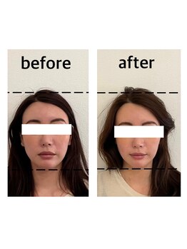 シン(SHINE)/美容鍼灸プレミアム