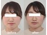 【学割U24】】美容鍼／フェイスラインのむくみ・エラ張り・たるみに ¥2200