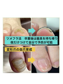 ナチュエイド/巻き爪矯正・肥厚爪自爪育成