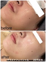 イル 名取店(iru)/プラズマフェイシャル