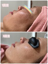 エシャーム(echarme)/Eライト　くすみ・シミ改善