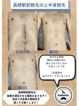 長崎駅前脱毛/【上半身脱毛】スッキリまで