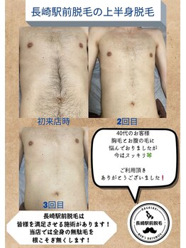 長崎駅前脱毛/【上半身脱毛】スッキリまで