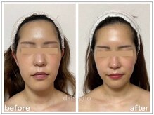 ダルセーニョ/小顔の途中段階なので～