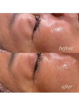 シュカ(Shuka)/ハーブピーリング