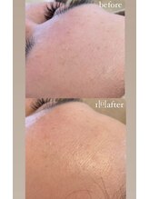 クレヴィー(Creviy)/潤艶wax脱毛(産毛脱毛)1回施術