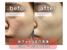 アネラ(anela)/光フォト＋ハイドラ毛穴洗浄