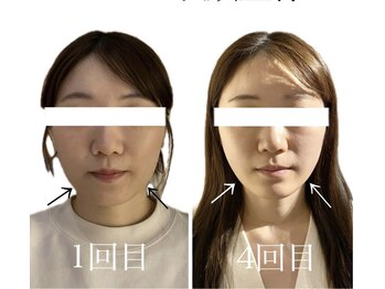 エクレクティック(ECLECTIC)/エラ張り/食いしばり/小顔