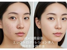 憩いサロン ユリ(yuri)/エレクトロポーレション導入