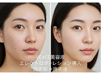 憩いサロン ユリ(yuri)/エレクトロポーレション導入