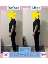 腰の整体インターセクション/美容整体　ビフォーアフター