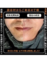 メンズディースタイル 首里店(Men's Dstyle)/那覇メンズ脱毛 Before After