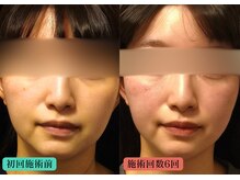 やなけん 亀戸店の雰囲気（電気美容鍼×LEDでエラ張り,たるみを改善してシュッとした小顔）