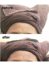 ブランシェ 金沢店 × 椿/シワ・たるみケア　お客様