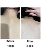 プロジェクトサン ムーンベル(PROjECTSuN Moonbell)/小学生　脱毛(男女)