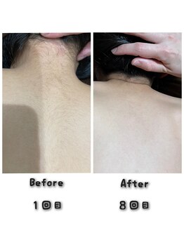 プロジェクトサン ムーンベル(PROjECTSuN Moonbell)/小学生 脱毛(男女)