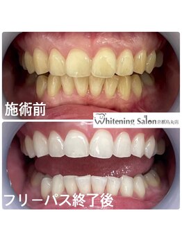 ホワイトニングサロン 京都烏丸店/ホワイトニング施術例